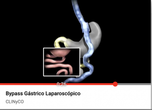 VIDEO BYPASS GASTRICO