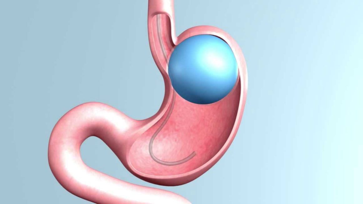 Nuevo Balón Intragástrico dura hasta 12 meses