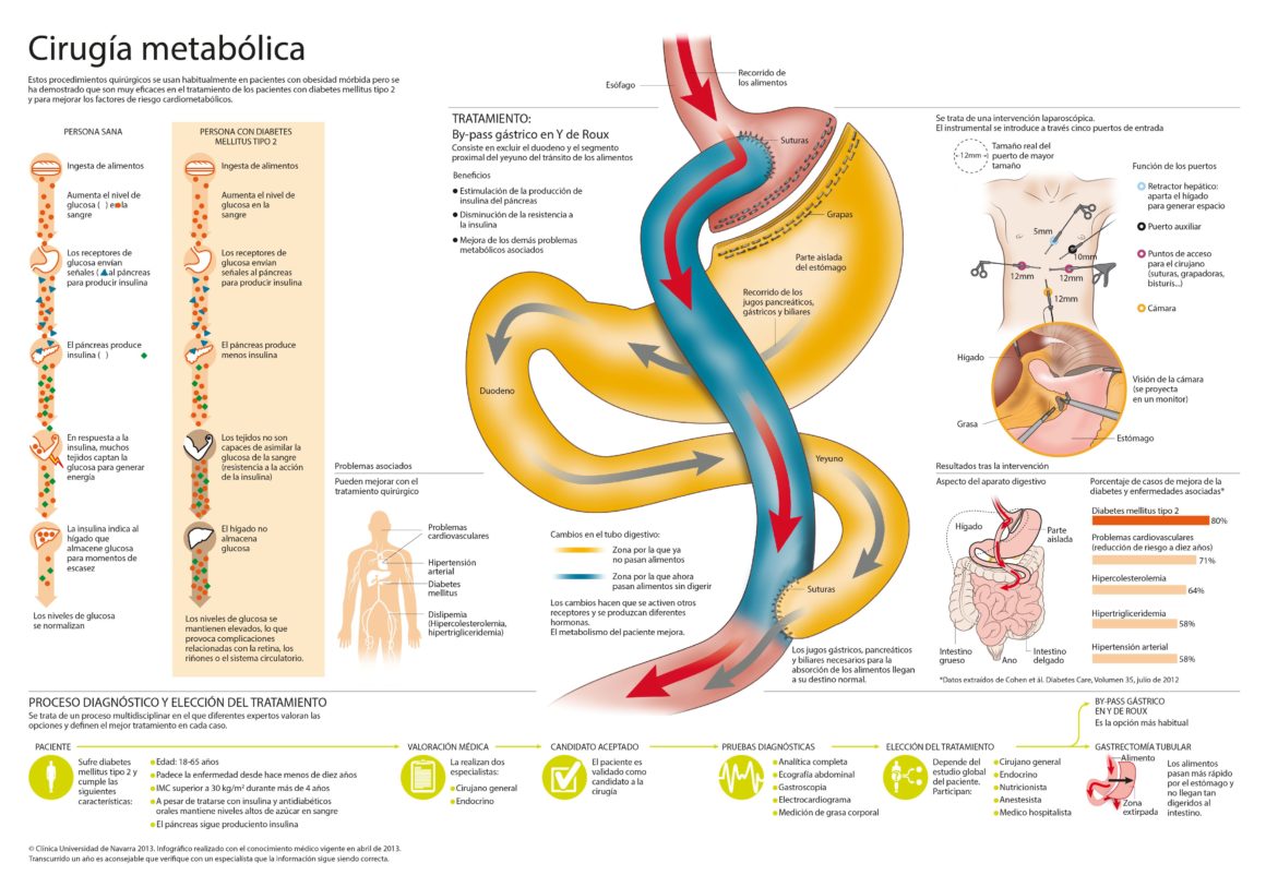 Cirugía metabólica para diabetes: Pese a las recomendaciones, muy pocos pacientes se operan