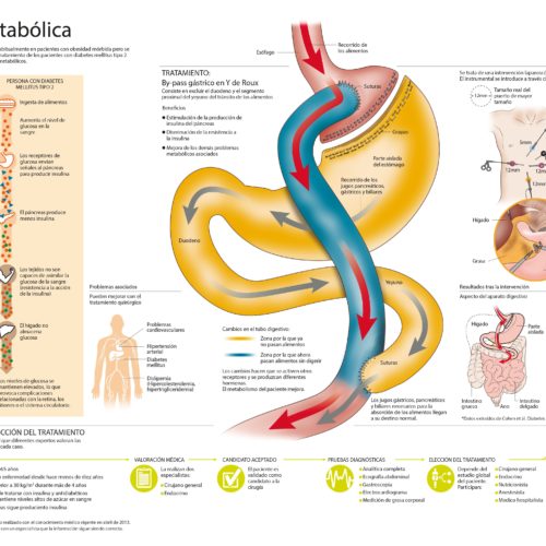 Cirugía metabólica para diabetes: Pese a las recomendaciones, muy pocos pacientes se operan